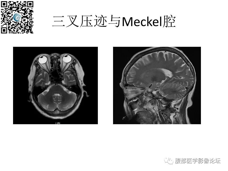影像PPT - 【PPT】颅骨颅底系列之岩洞深处住神仙-22