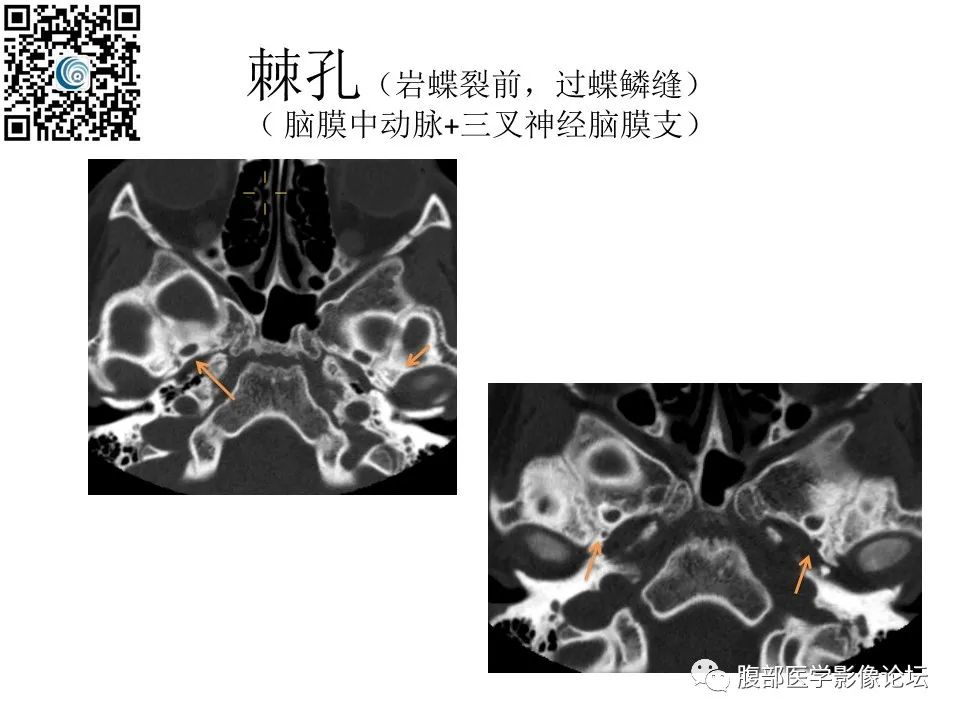 影像PPT - 【PPT】颅骨颅底系列之岩洞深处住神仙-24