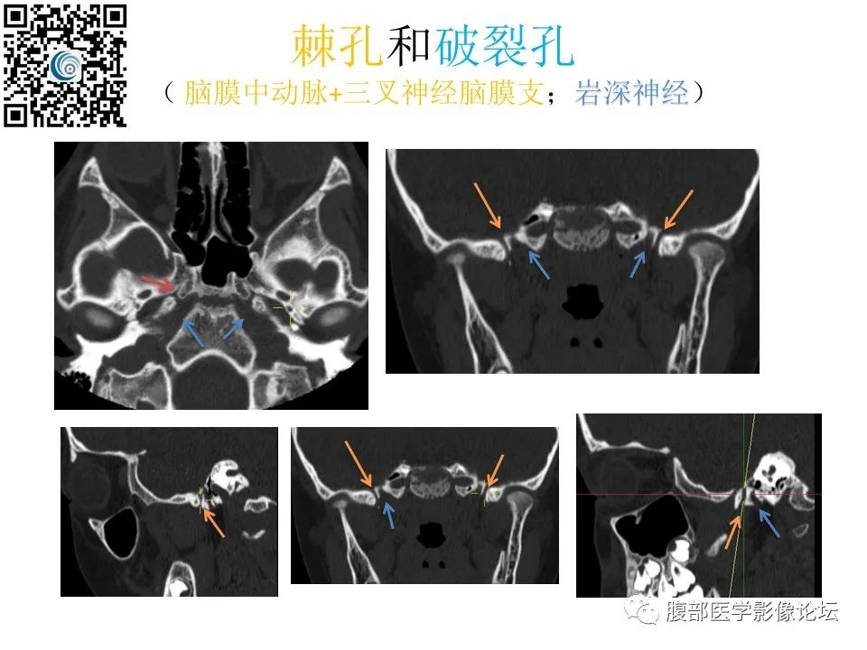 影像PPT - 【PPT】颅骨颅底系列之岩洞深处住神仙-23