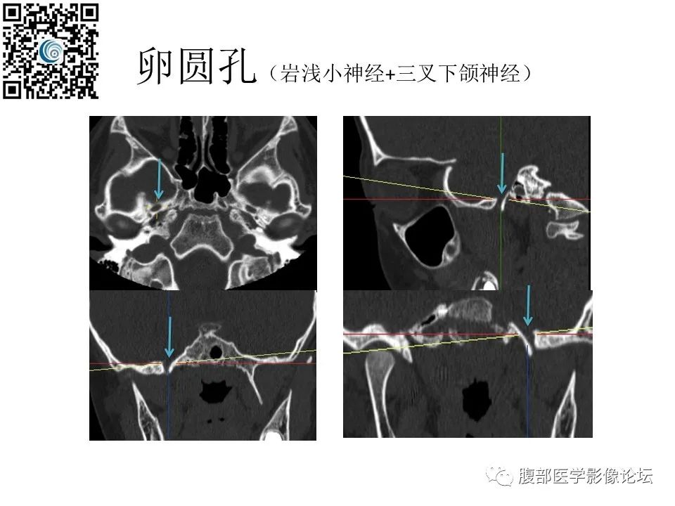 影像PPT - 【PPT】颅骨颅底系列之岩洞深处住神仙-25