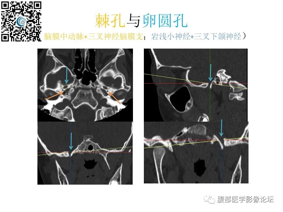 影像PPT - 【PPT】颅骨颅底系列之岩洞深处住神仙-26