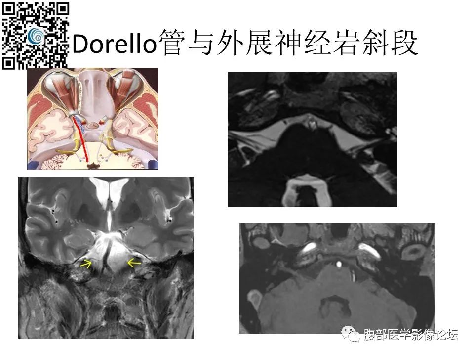 影像PPT - 【PPT】颅骨颅底系列之岩洞深处住神仙-28
