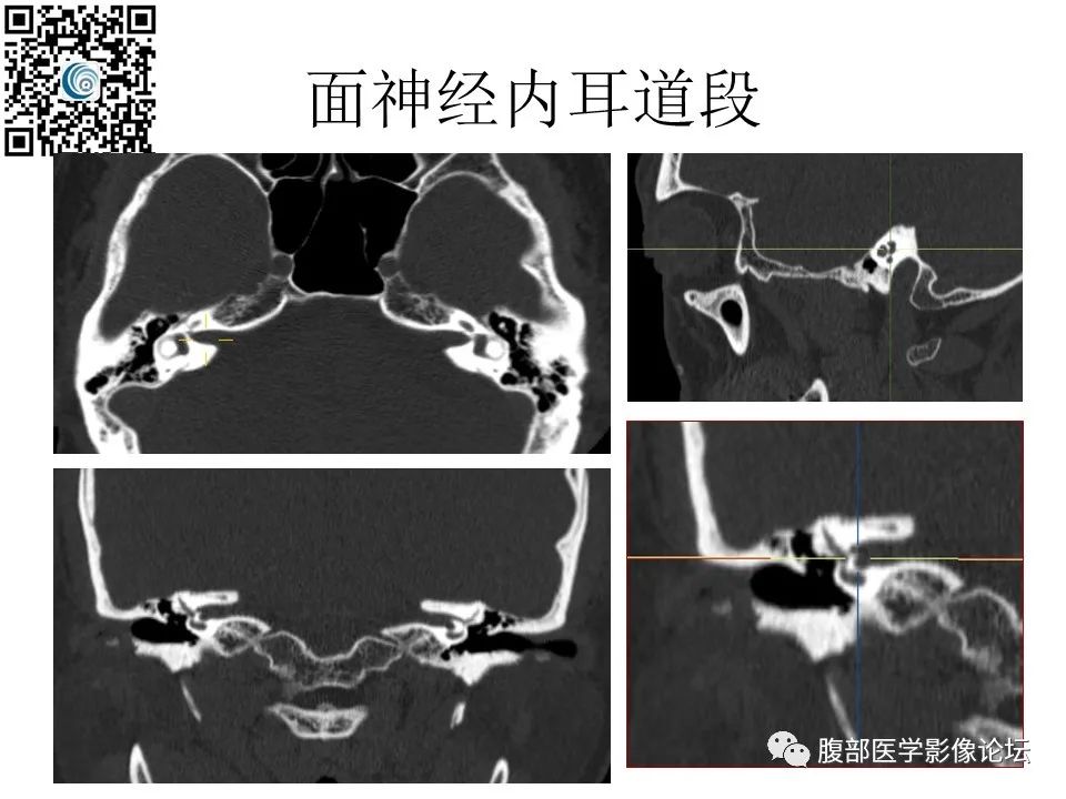 影像PPT - 【PPT】颅骨颅底系列之岩洞深处住神仙-30