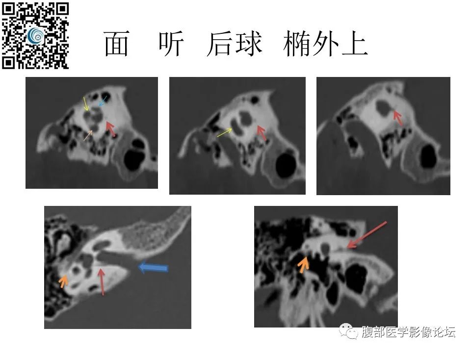 影像PPT - 【PPT】颅骨颅底系列之岩洞深处住神仙-35