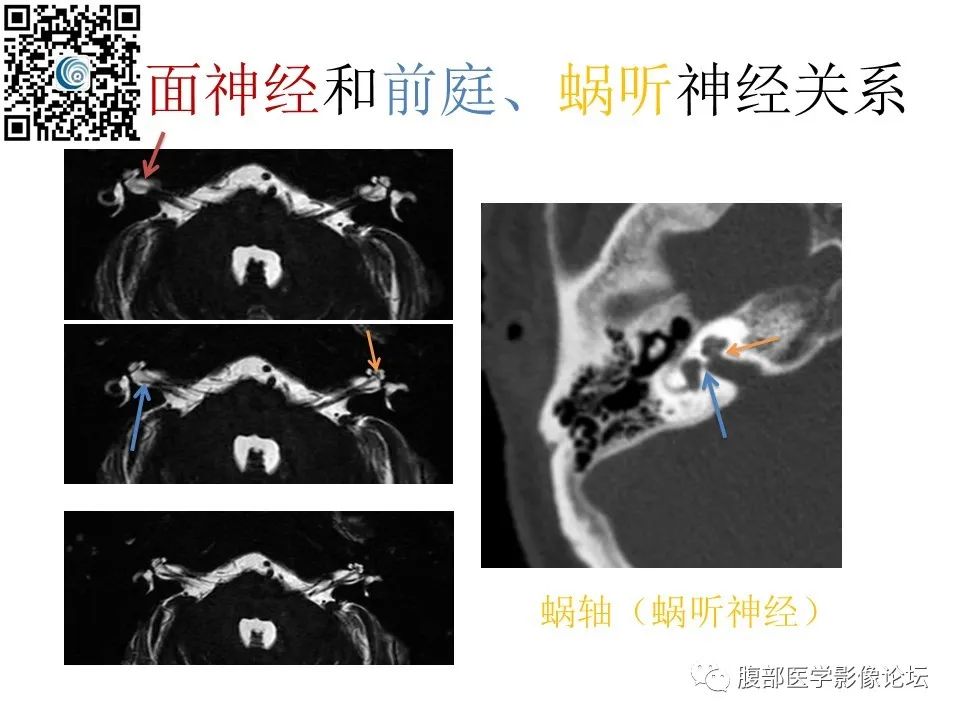 影像PPT - 【PPT】颅骨颅底系列之岩洞深处住神仙-37