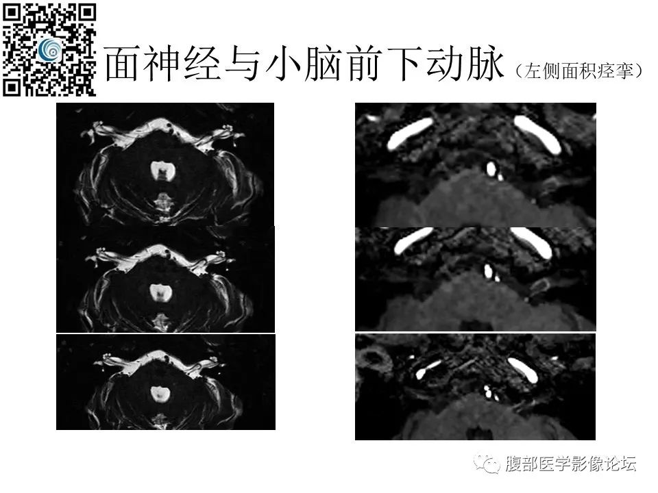 影像PPT - 【PPT】颅骨颅底系列之岩洞深处住神仙-40