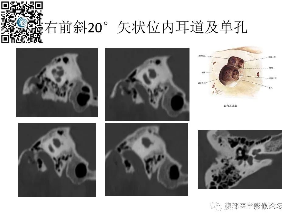 影像PPT - 【PPT】颅骨颅底系列之岩洞深处住神仙-41