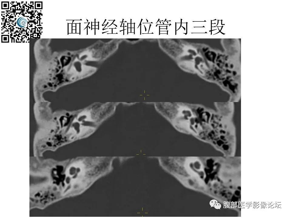 影像PPT - 【PPT】颅骨颅底系列之岩洞深处住神仙-44