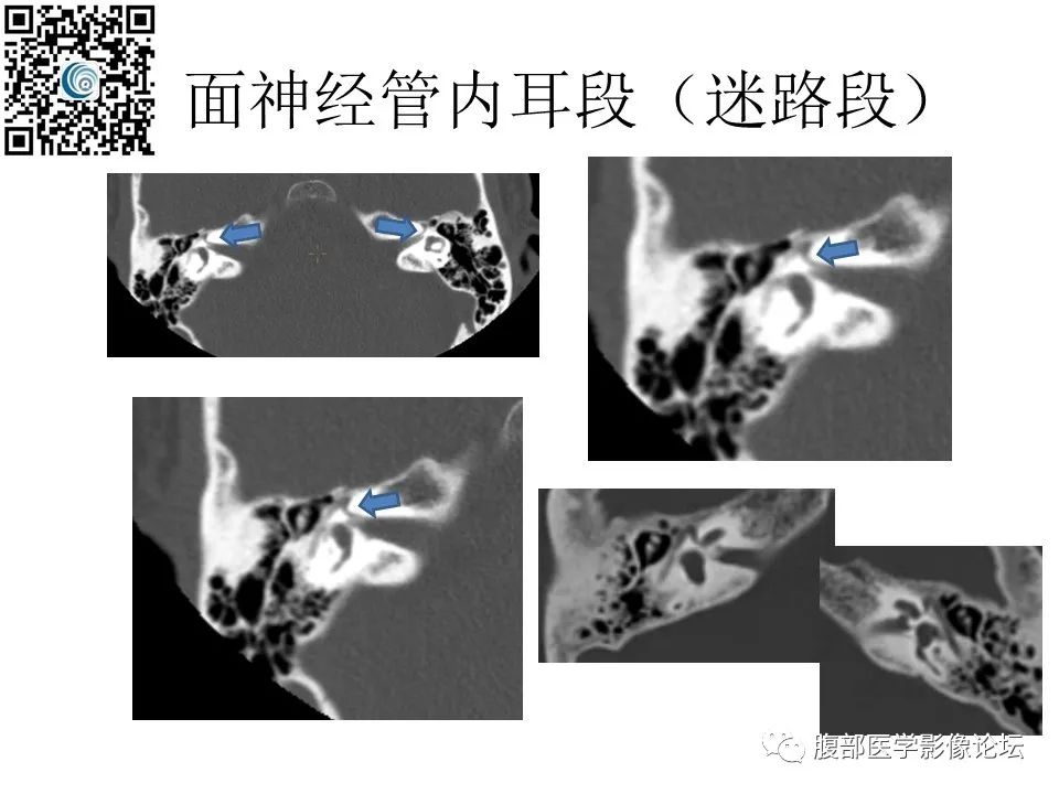影像PPT - 【PPT】颅骨颅底系列之岩洞深处住神仙-45
