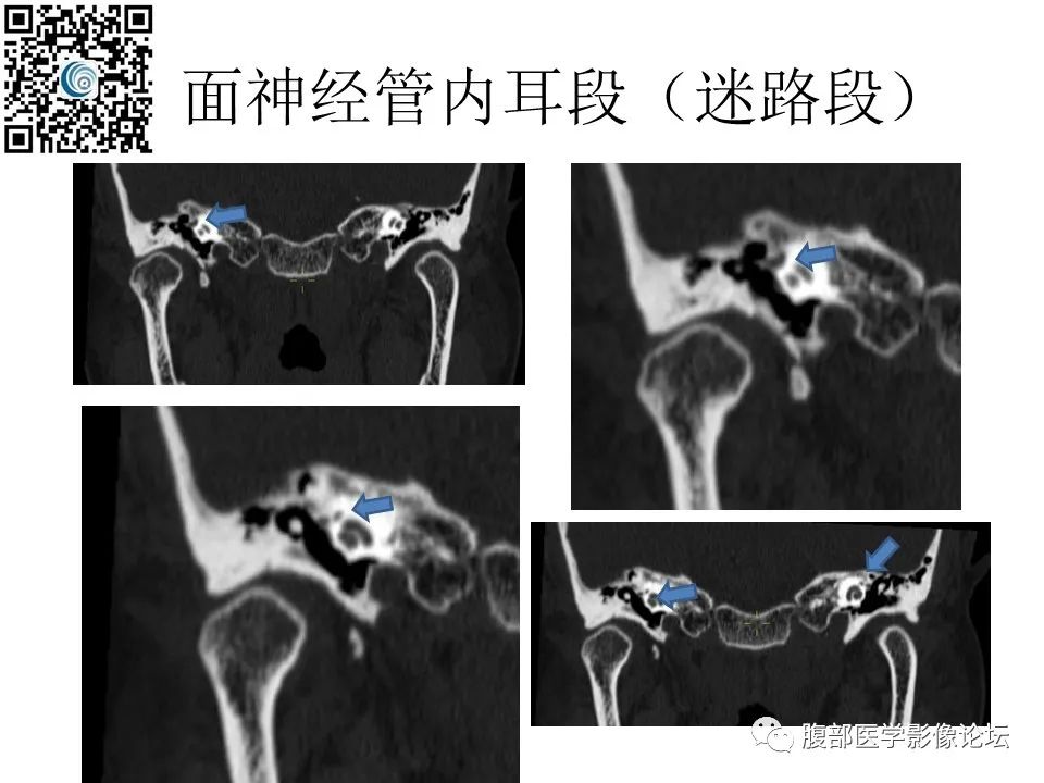 影像PPT - 【PPT】颅骨颅底系列之岩洞深处住神仙-46