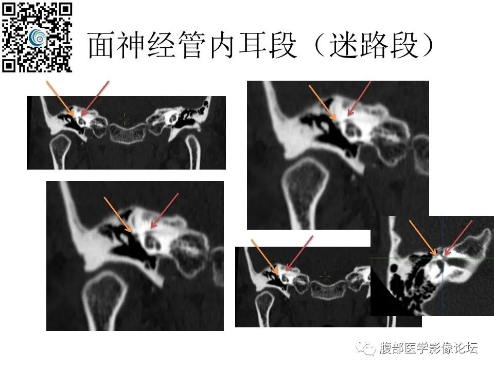 影像PPT - 【PPT】颅骨颅底系列之岩洞深处住神仙-47