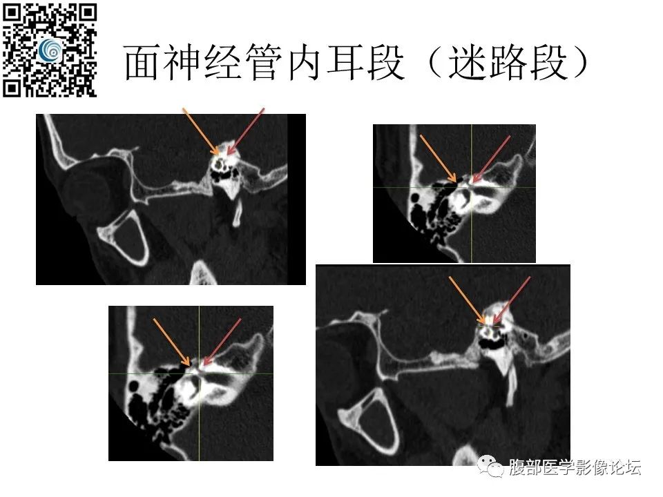 影像PPT - 【PPT】颅骨颅底系列之岩洞深处住神仙-48