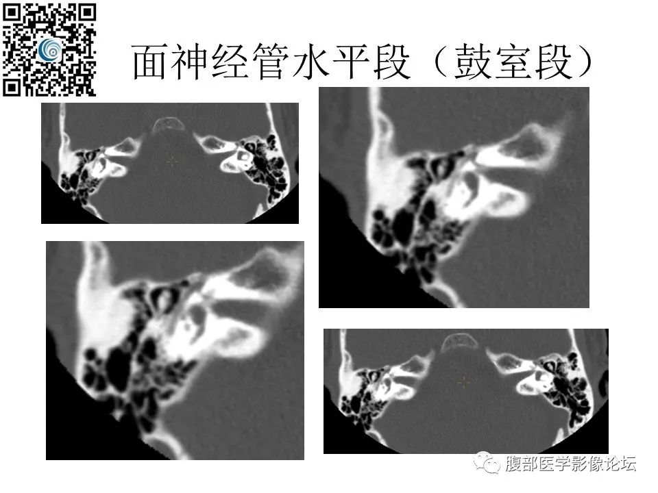 影像PPT - 【PPT】颅骨颅底系列之岩洞深处住神仙-50