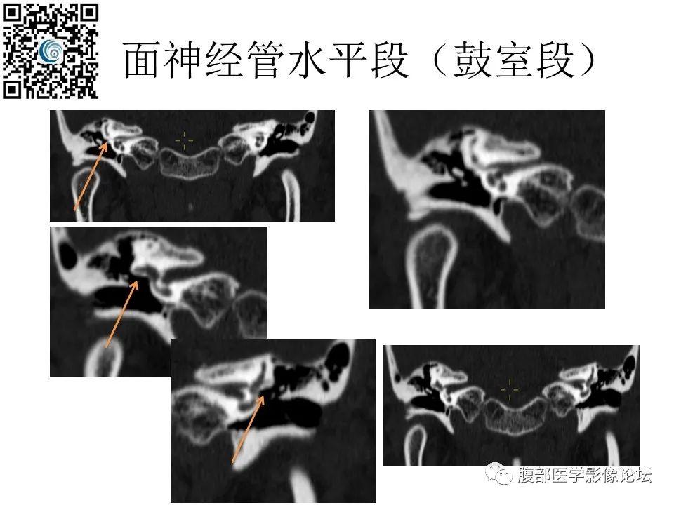 影像PPT - 【PPT】颅骨颅底系列之岩洞深处住神仙-51