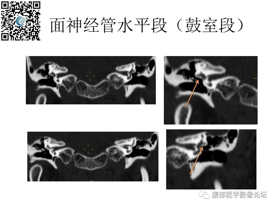 影像PPT - 【PPT】颅骨颅底系列之岩洞深处住神仙-52