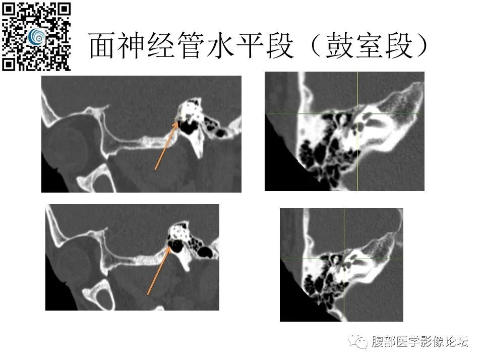 影像PPT - 【PPT】颅骨颅底系列之岩洞深处住神仙-53