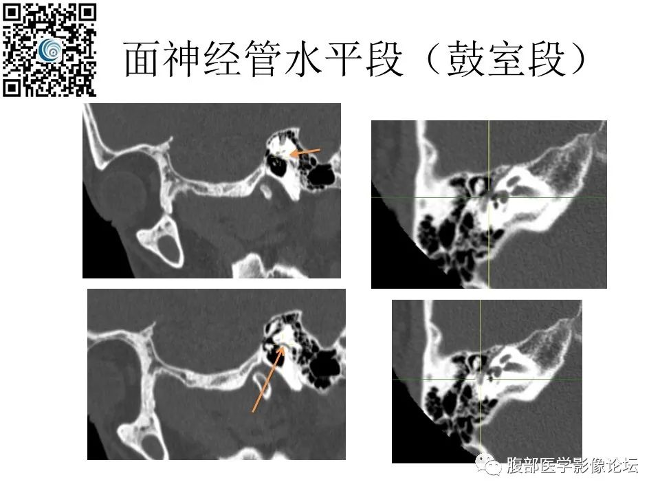 影像PPT - 【PPT】颅骨颅底系列之岩洞深处住神仙-54