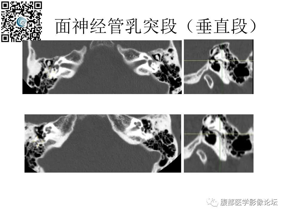 影像PPT - 【PPT】颅骨颅底系列之岩洞深处住神仙-55