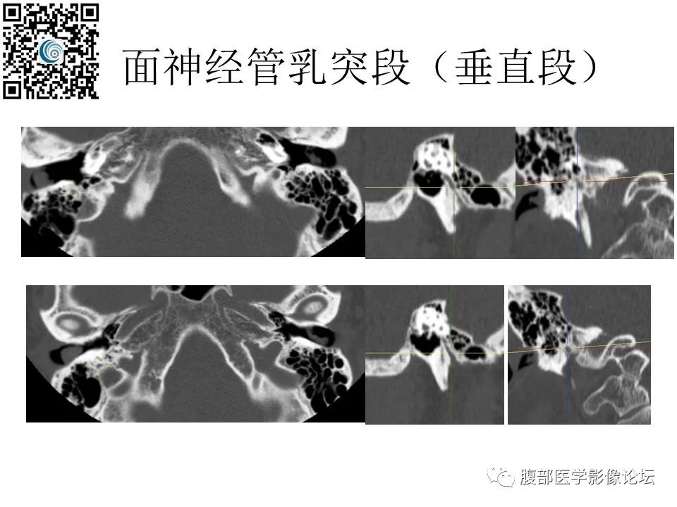 影像PPT - 【PPT】颅骨颅底系列之岩洞深处住神仙-56