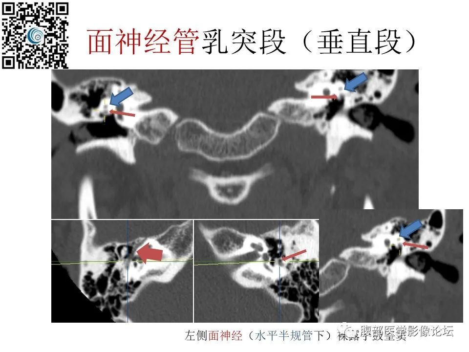 影像PPT - 【PPT】颅骨颅底系列之岩洞深处住神仙-57