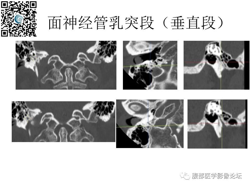 影像PPT - 【PPT】颅骨颅底系列之岩洞深处住神仙-58