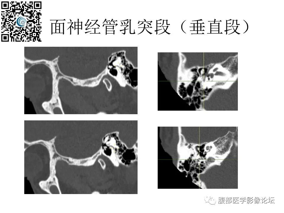 影像PPT - 【PPT】颅骨颅底系列之岩洞深处住神仙-59