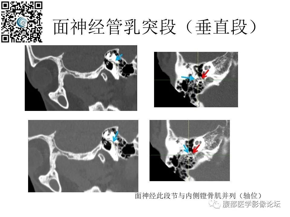 影像PPT - 【PPT】颅骨颅底系列之岩洞深处住神仙-60