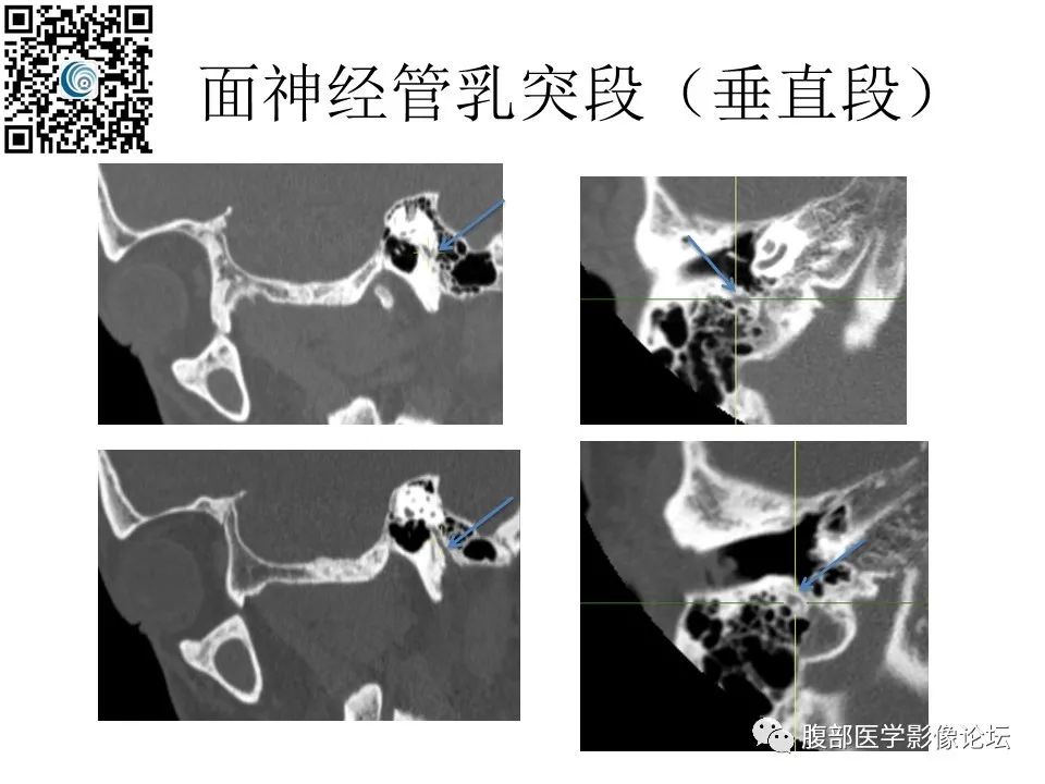 影像PPT - 【PPT】颅骨颅底系列之岩洞深处住神仙-61