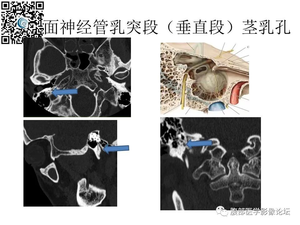 影像PPT - 【PPT】颅骨颅底系列之岩洞深处住神仙-62