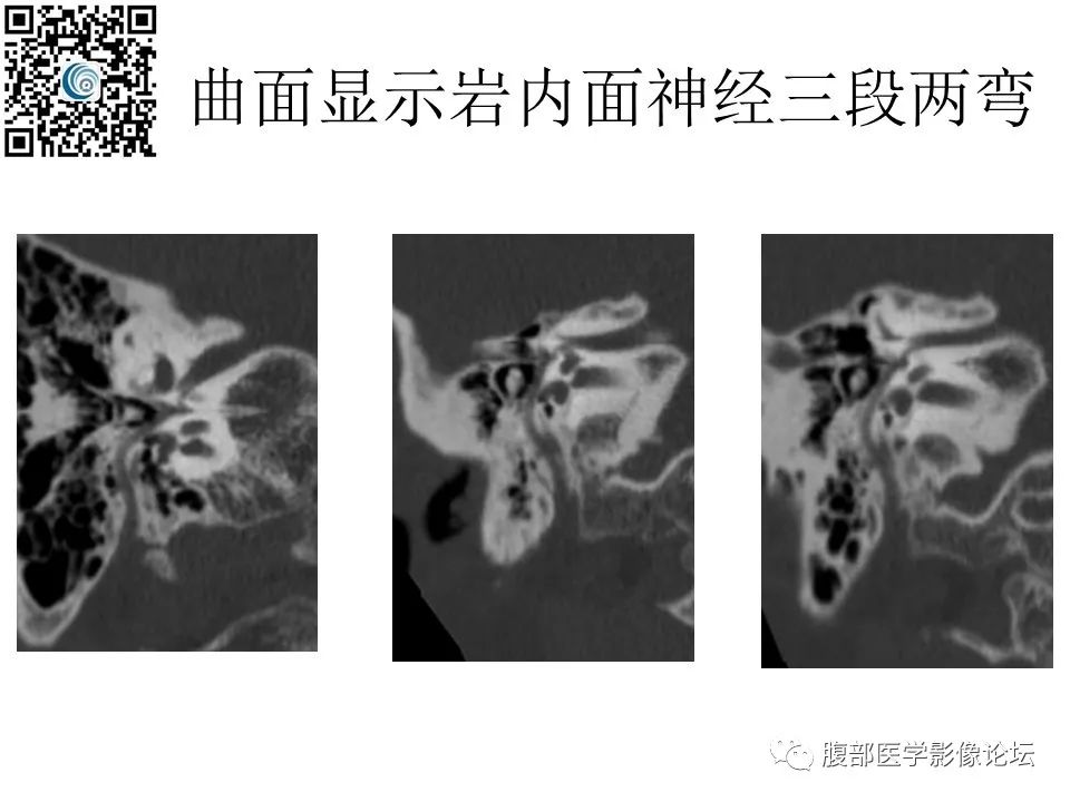 影像PPT - 【PPT】颅骨颅底系列之岩洞深处住神仙-63