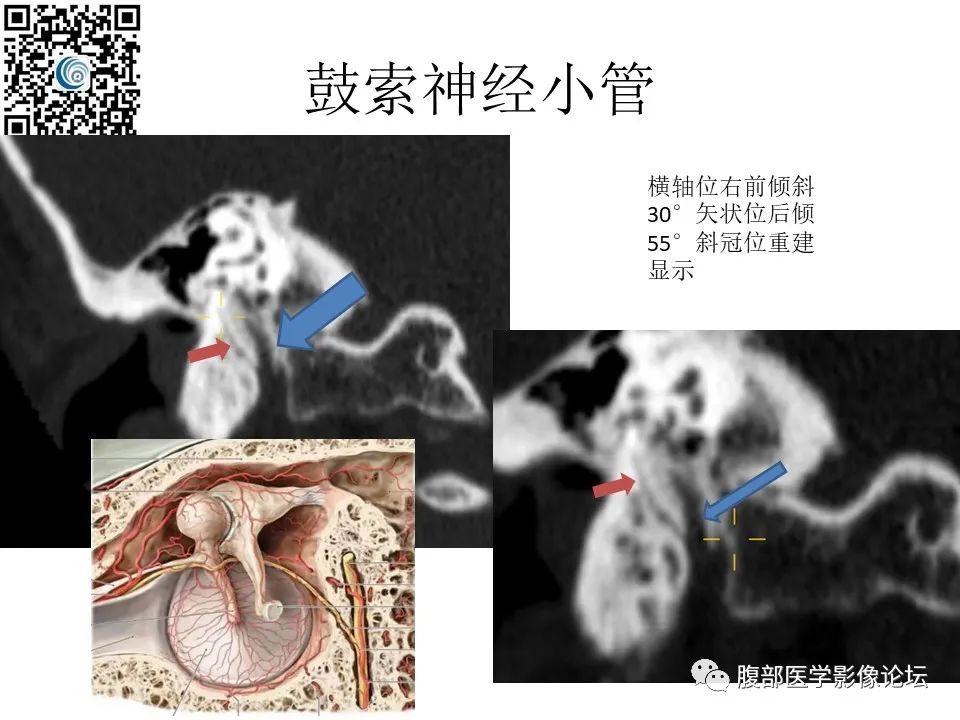影像PPT - 【PPT】颅骨颅底系列之岩洞深处住神仙-65