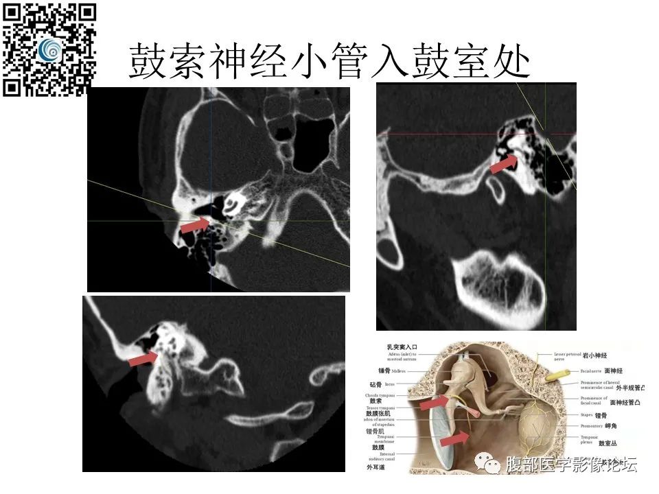 影像PPT - 【PPT】颅骨颅底系列之岩洞深处住神仙-67