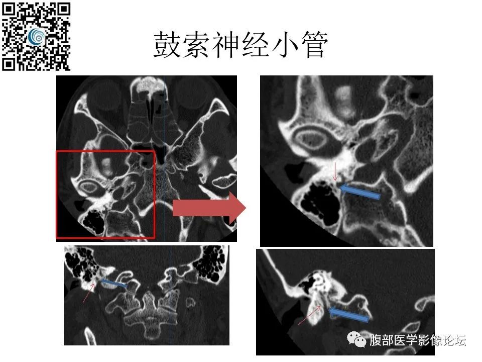 影像PPT - 【PPT】颅骨颅底系列之岩洞深处住神仙-64
