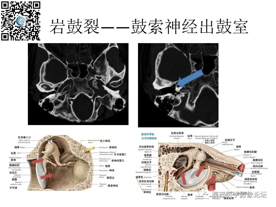 影像PPT - 【PPT】颅骨颅底系列之岩洞深处住神仙-68
