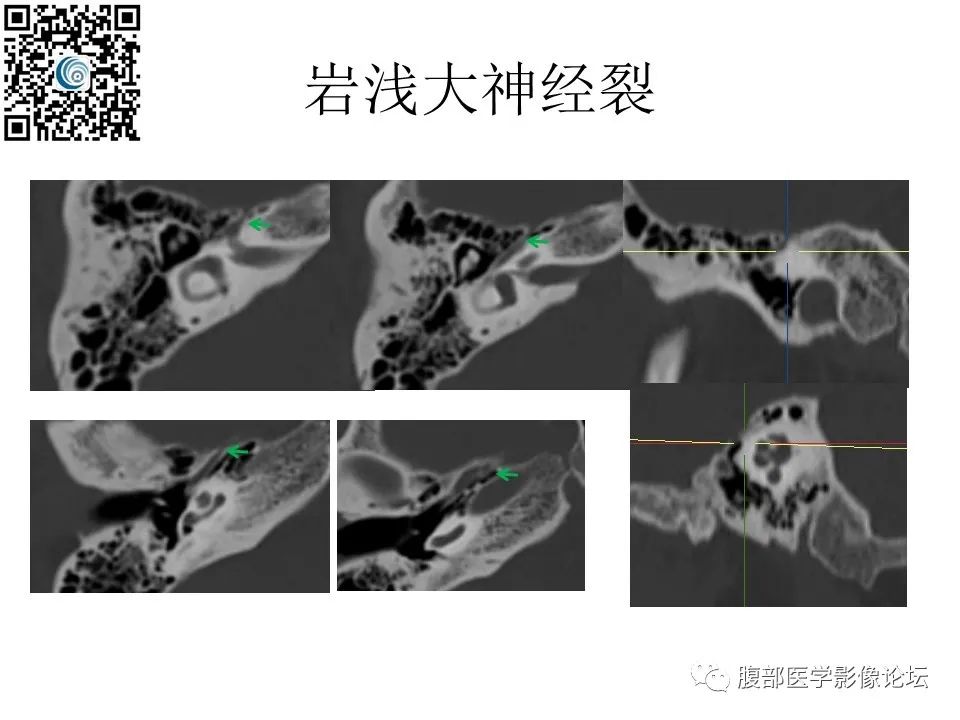 影像PPT - 【PPT】颅骨颅底系列之岩洞深处住神仙-69