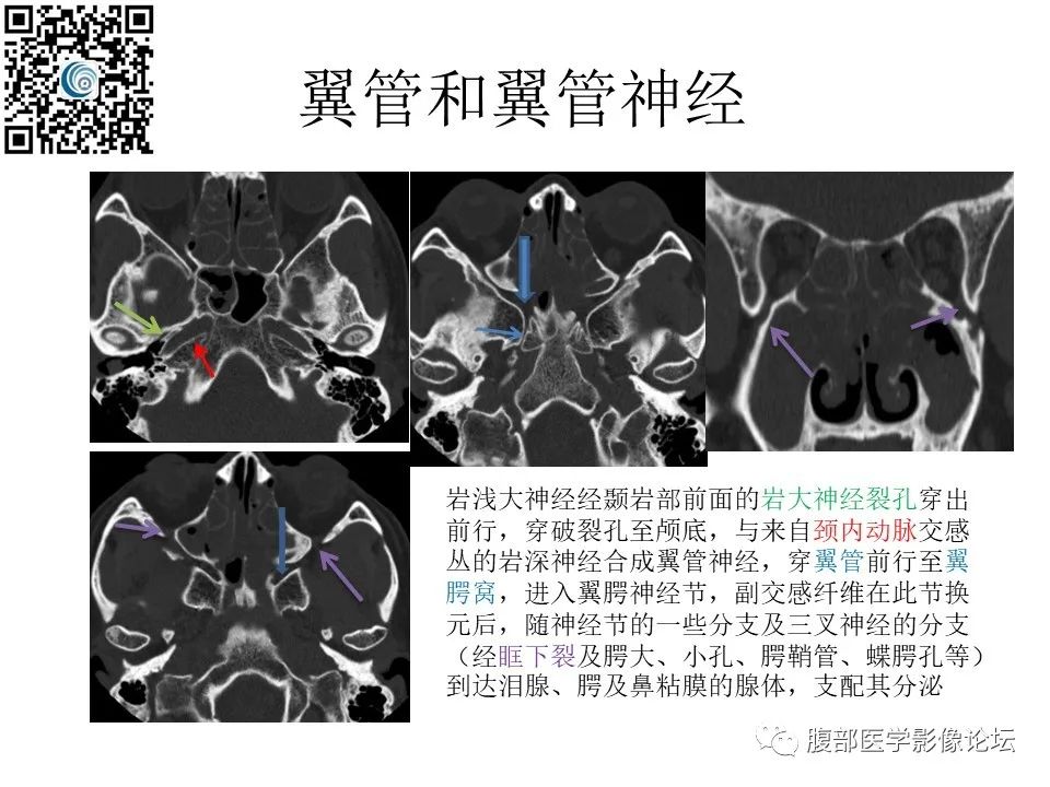 影像PPT - 【PPT】颅骨颅底系列之岩洞深处住神仙-71