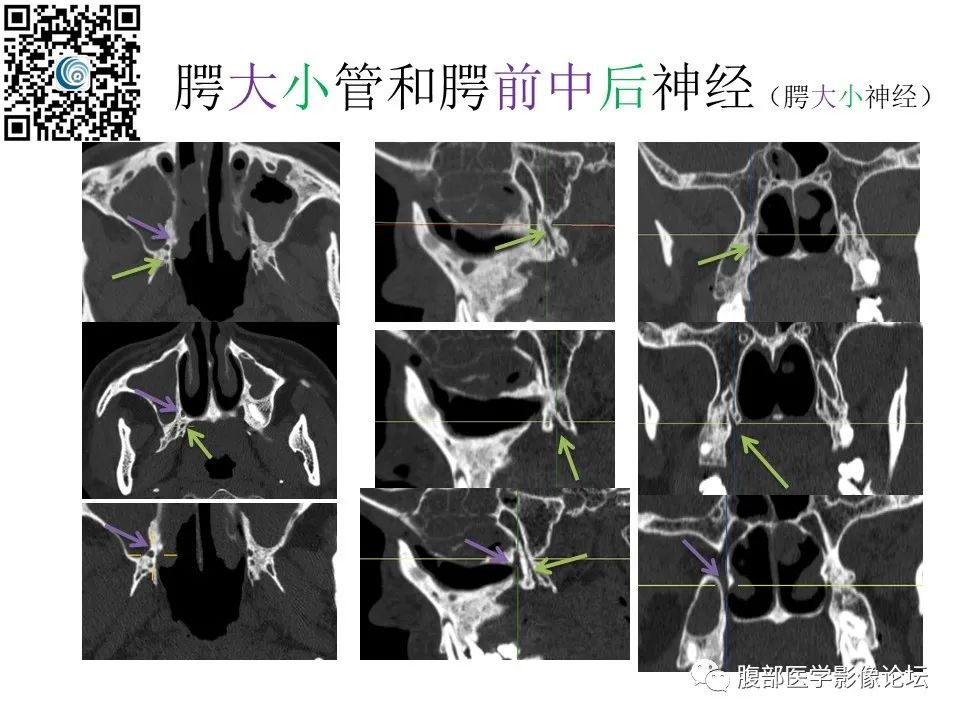 影像PPT - 【PPT】颅骨颅底系列之岩洞深处住神仙-73
