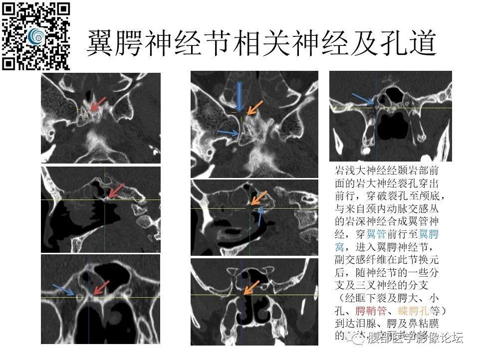 影像PPT - 【PPT】颅骨颅底系列之岩洞深处住神仙-72