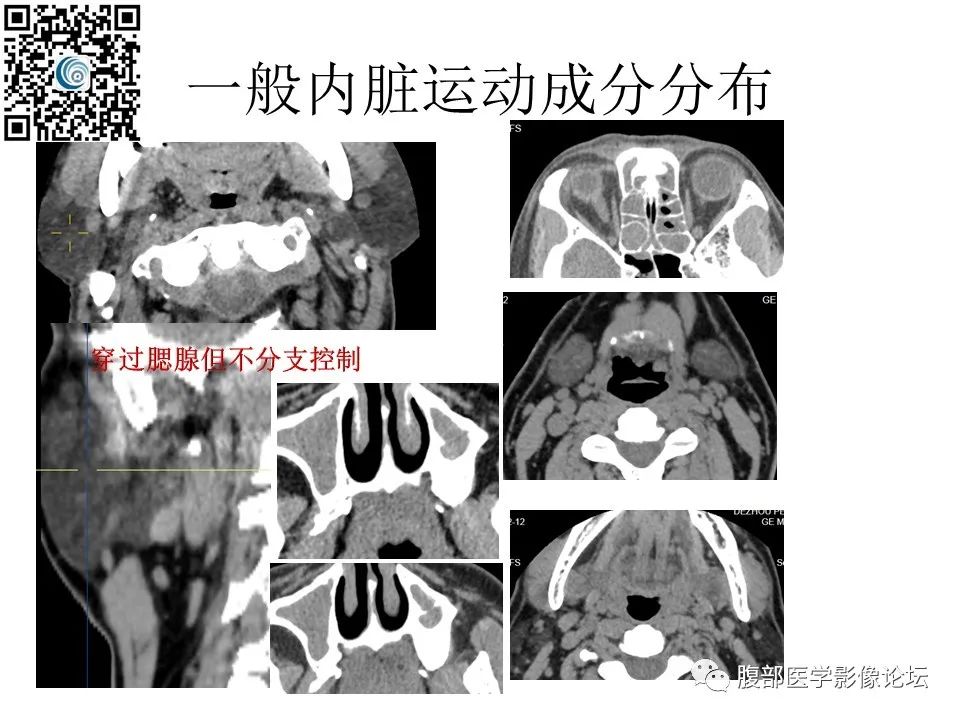 影像PPT - 【PPT】颅骨颅底系列之岩洞深处住神仙-74