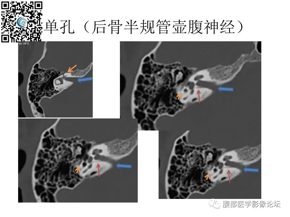 影像PPT - 【PPT】颅骨颅底系列之岩洞深处住神仙-76