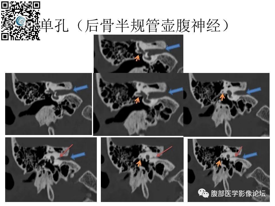 影像PPT - 【PPT】颅骨颅底系列之岩洞深处住神仙-77