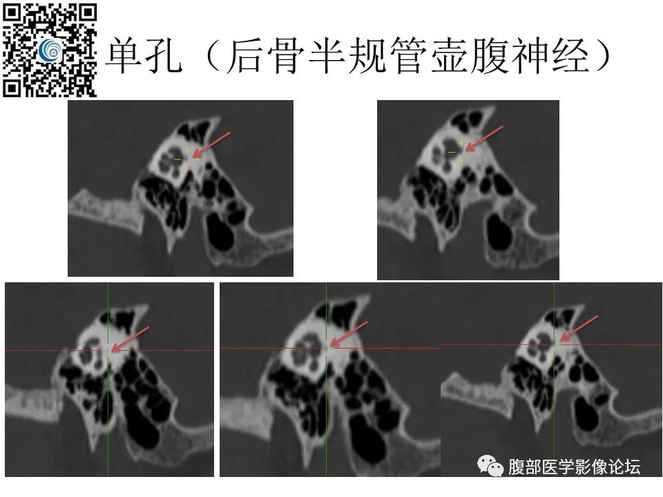 影像PPT - 【PPT】颅骨颅底系列之岩洞深处住神仙-78