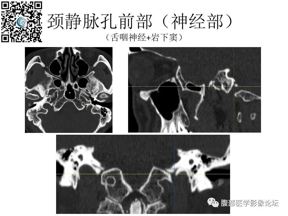影像PPT - 【PPT】颅骨颅底系列之岩洞深处住神仙-81