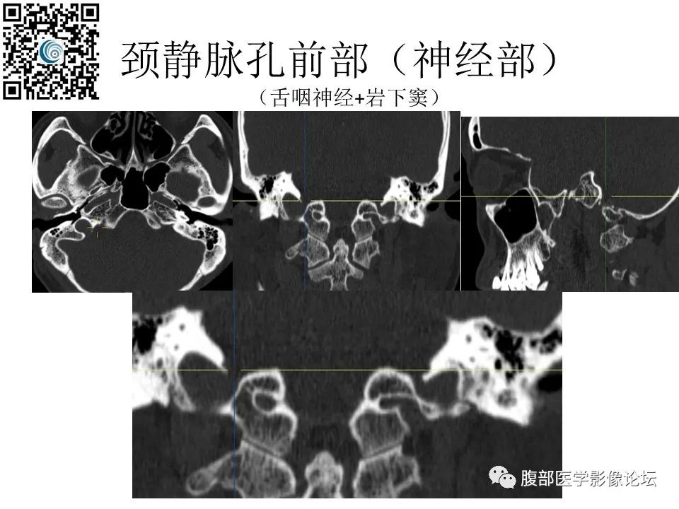 影像PPT - 【PPT】颅骨颅底系列之岩洞深处住神仙-82