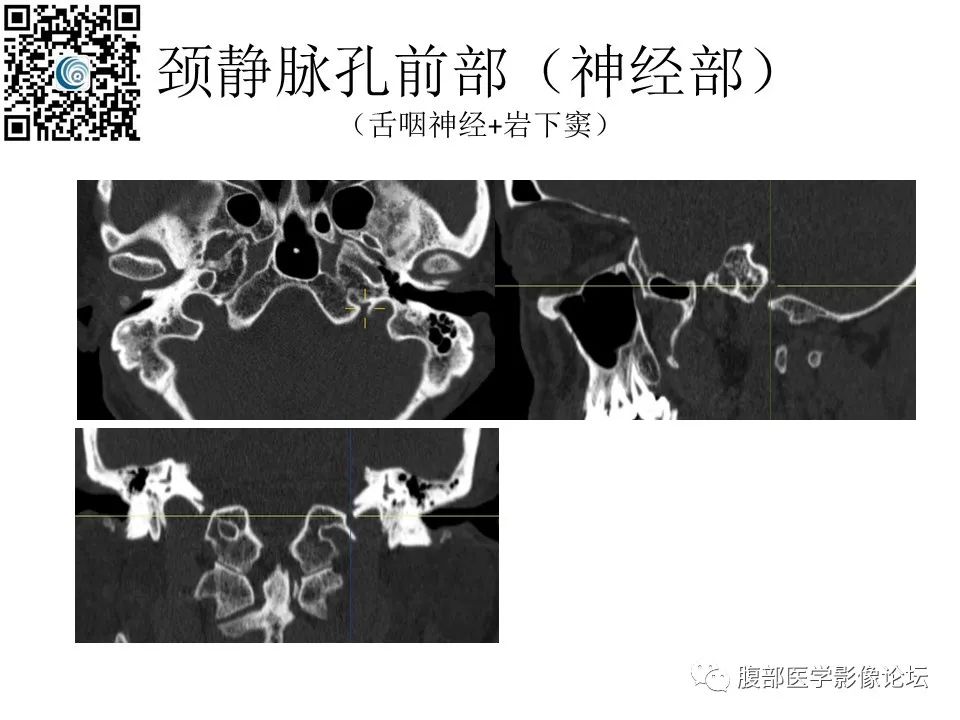 影像PPT - 【PPT】颅骨颅底系列之岩洞深处住神仙-80