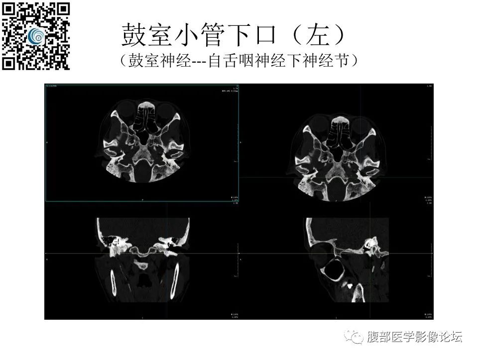 影像PPT - 【PPT】颅骨颅底系列之岩洞深处住神仙-86