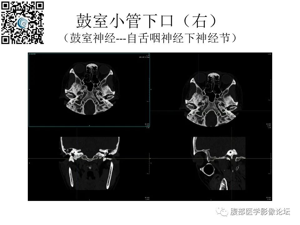 影像PPT - 【PPT】颅骨颅底系列之岩洞深处住神仙-85