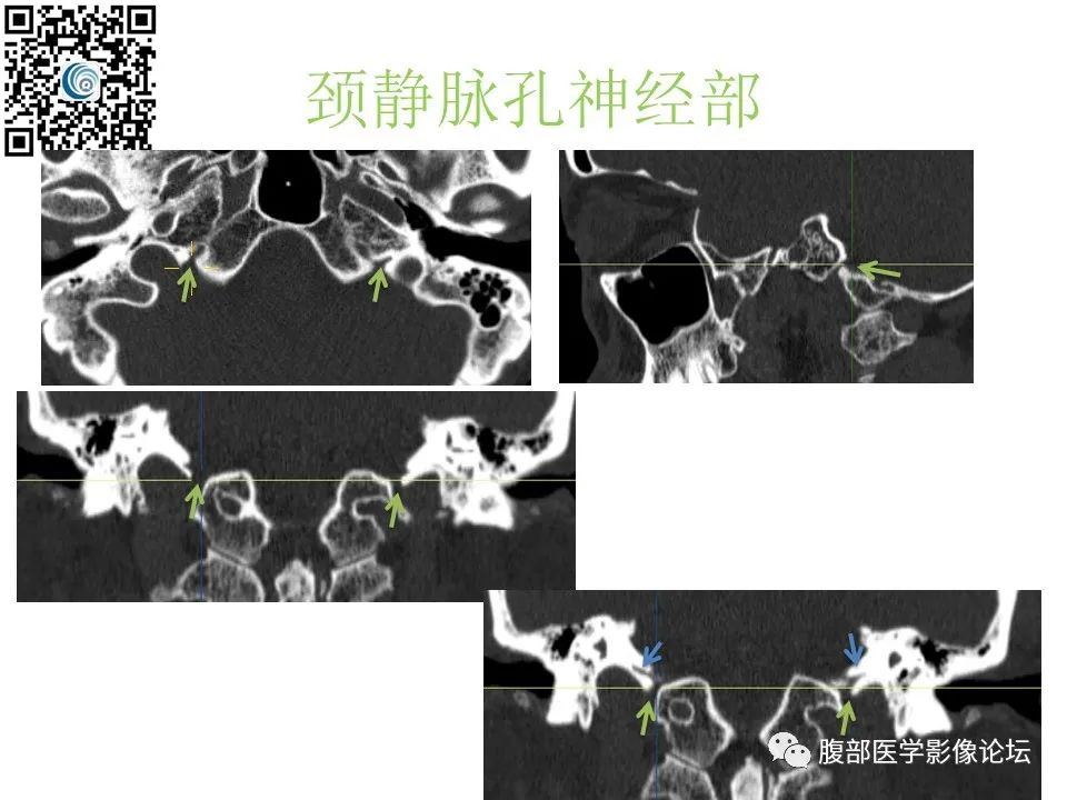 影像PPT - 【PPT】颅骨颅底系列之岩洞深处住神仙-84