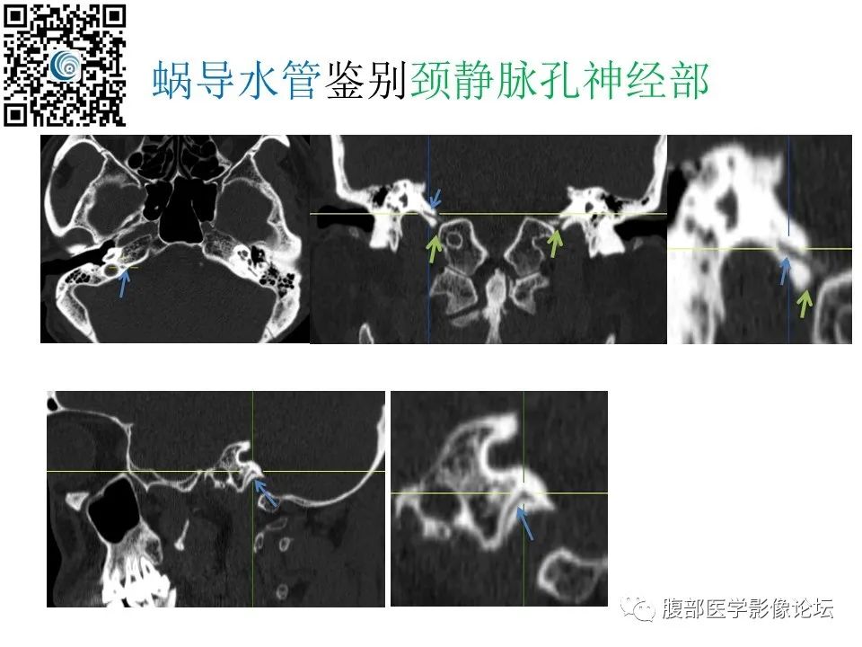 影像PPT - 【PPT】颅骨颅底系列之岩洞深处住神仙-83