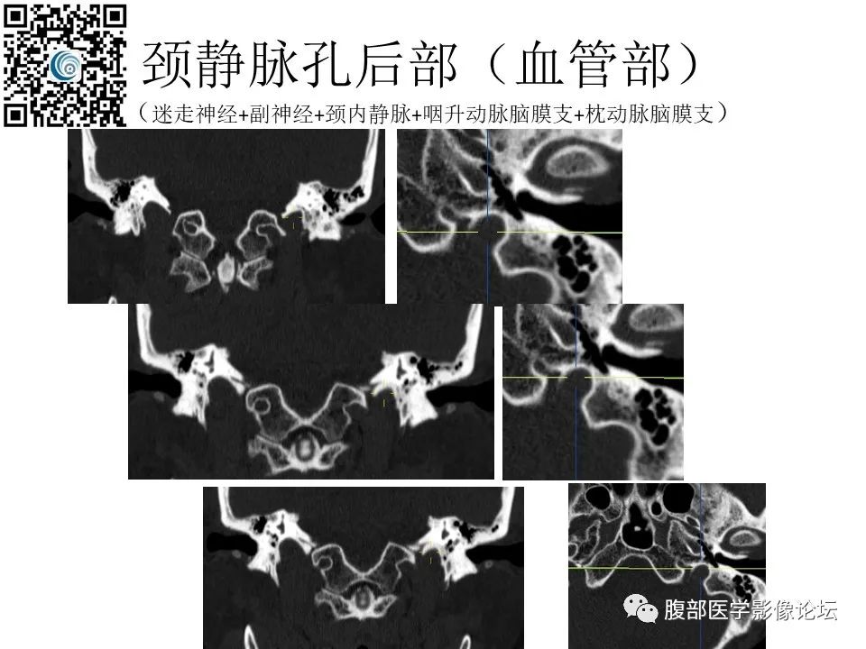 影像PPT - 【PPT】颅骨颅底系列之岩洞深处住神仙-88